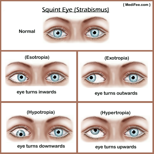 Do You Know About the Strabismus? Here's What to Do