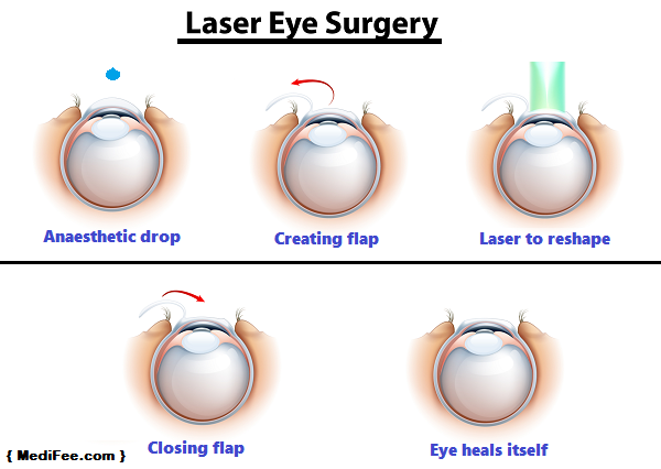 Laser Eye Treatment in India - Risks, Cost and Procedure