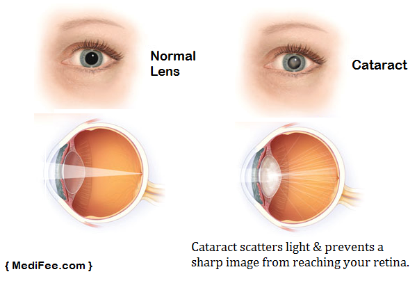 Cataract Treatment in India - Price, Procedure & Risks