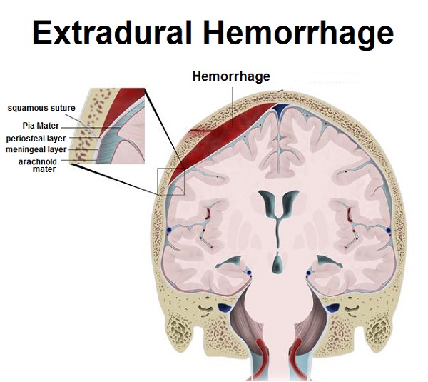 Brain Hemorrhage - Types, Causes and Prevention