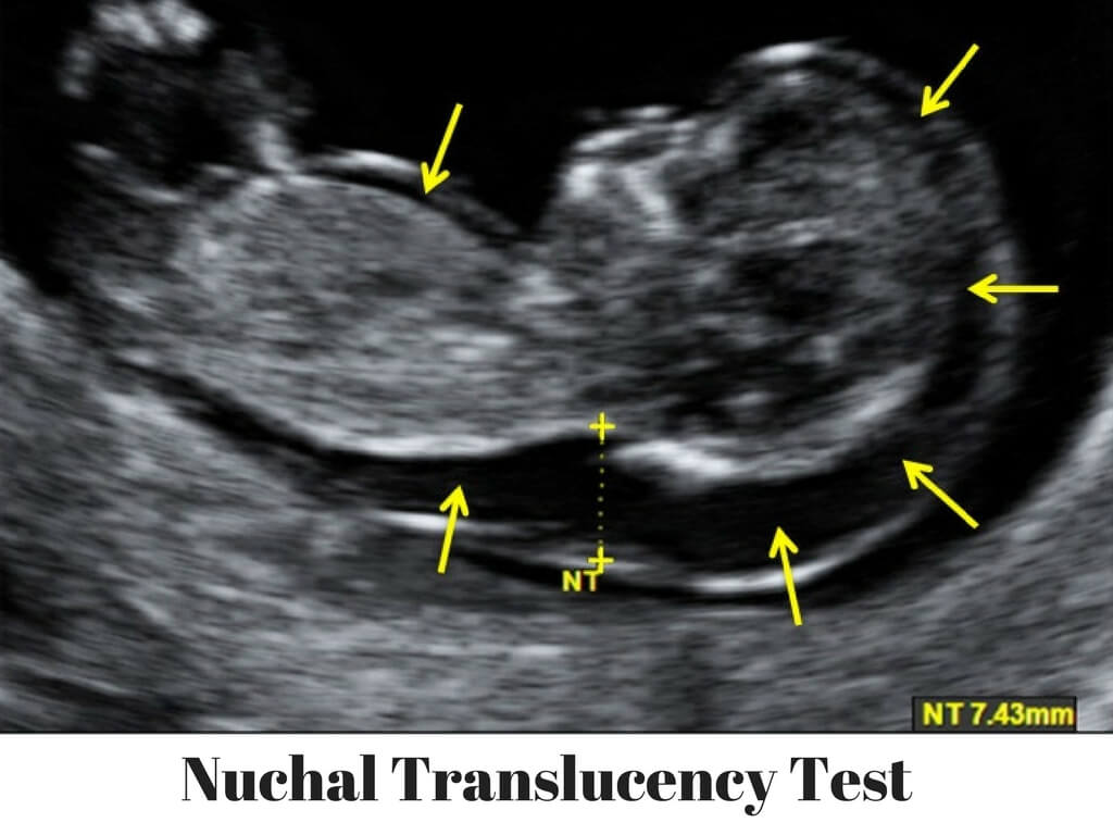 Nuchal Translucency Teat (NT Scan) Procedure To Detect Down Syndrome