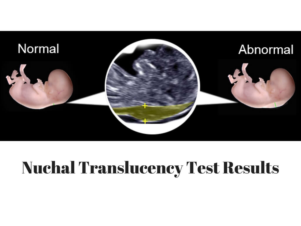 Nuchal Translucency (NT Scan) Procedure To Detect