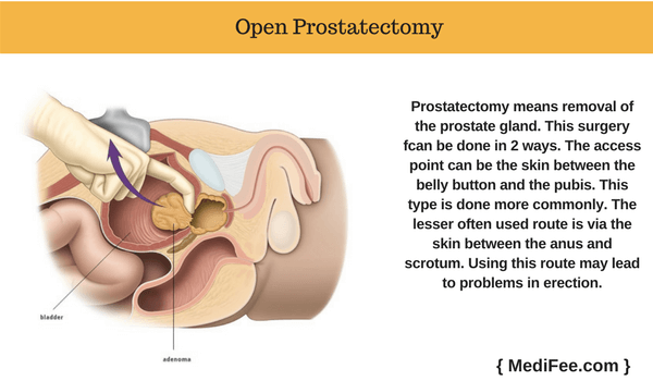 open prostatectomy