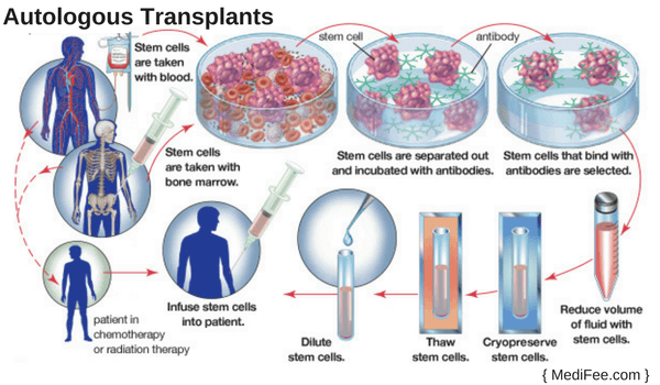 autologous transplants