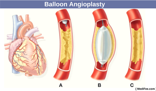 ballon angioplasty