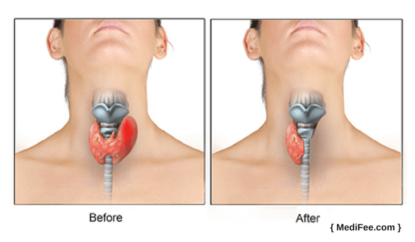 before and after thyroid cancer surgery