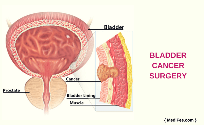 bladder Cancer bladder cancer