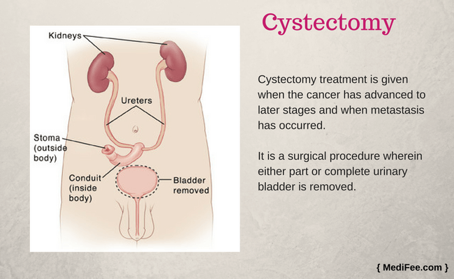 cystectomy cystectomy
