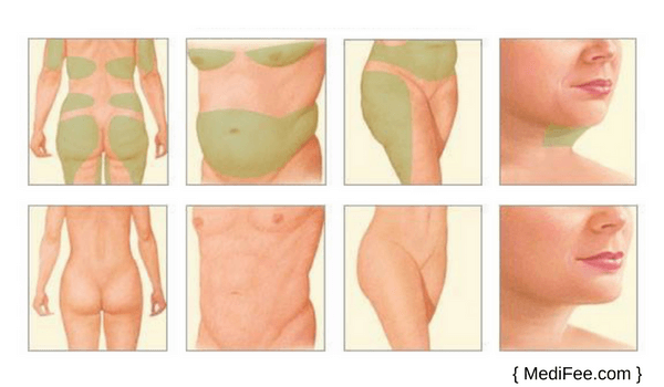 What is Body Contouring? Surgery Procedures and Risks