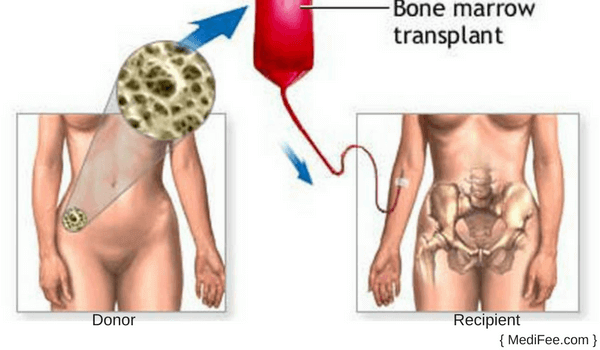 Bone Marrow Transplant