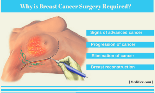 surgery to treat breast cancer