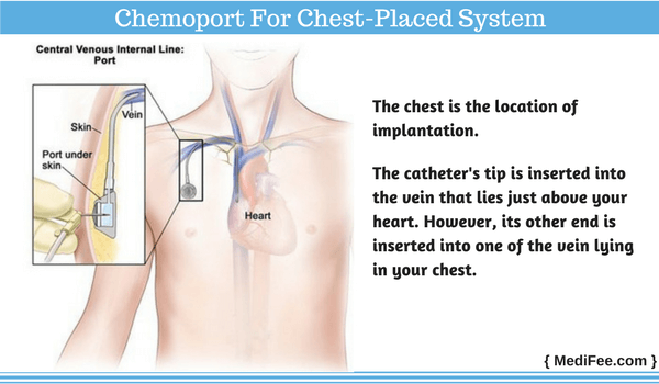 chest placed system in chemoport