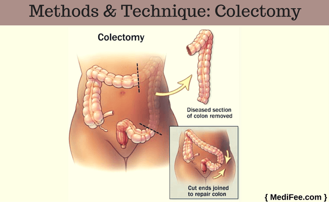 colectomy
