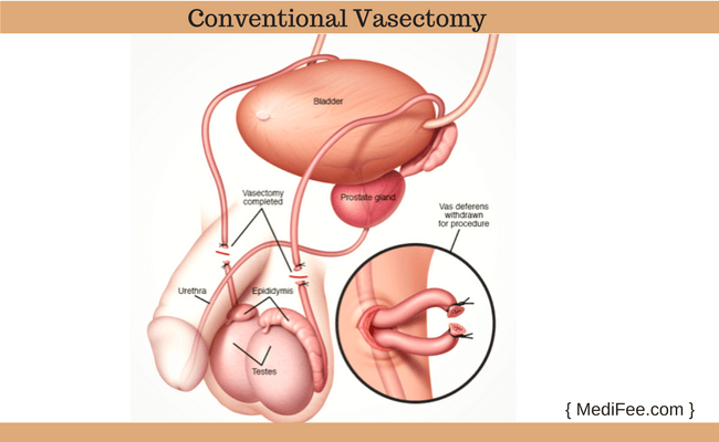 conventional  vasectomy procedure