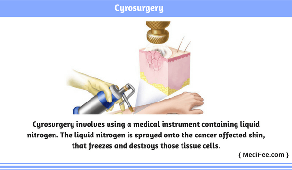 cyrosurgery