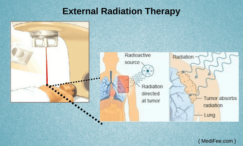 Radiation Therapy external