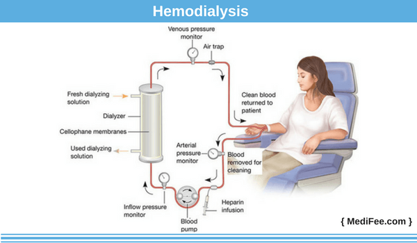 Method of dialysis: hemodialysis