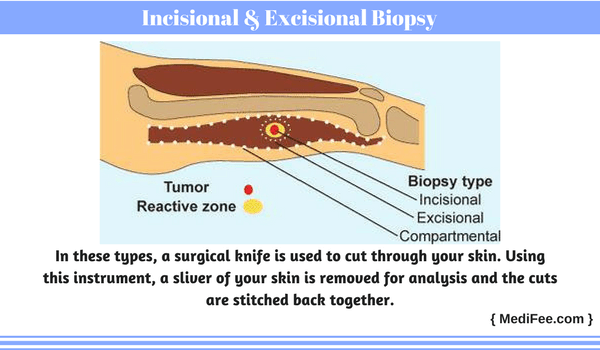sIncisional & Excisional Biopsies
