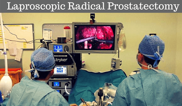 radical laparoscopic prostatectomy radical laparoscopic prostatectomy