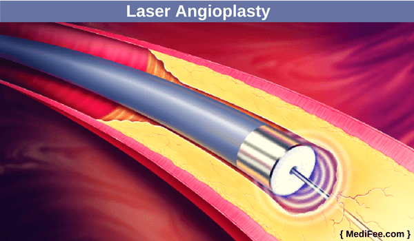 Angioplasty Surgery - Techniques and Procedure