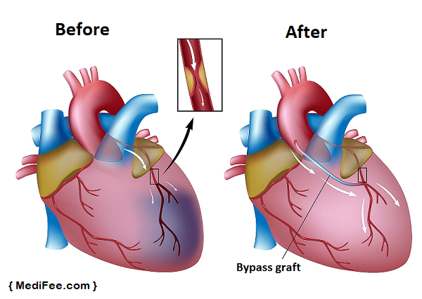 heart bypass surgery method