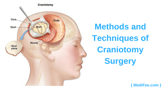 methods of craniotomy
