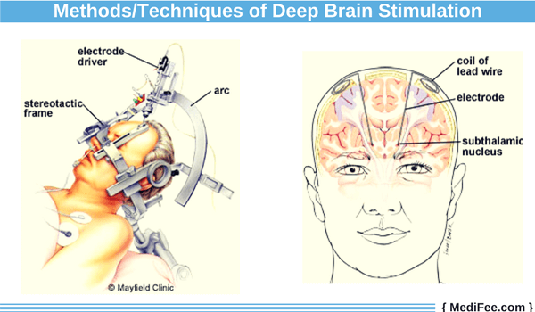 deep brain stimulation methods