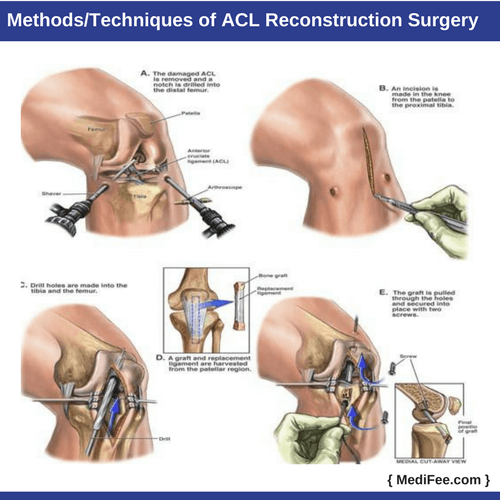 methods techniques of acl reconstruction surgery methods techniques of acl reconstruction surgery