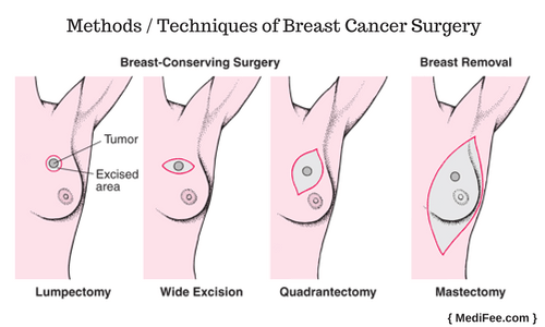 methods adopted for breast cancer surgery