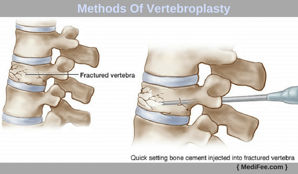 methods of vertebroplasty