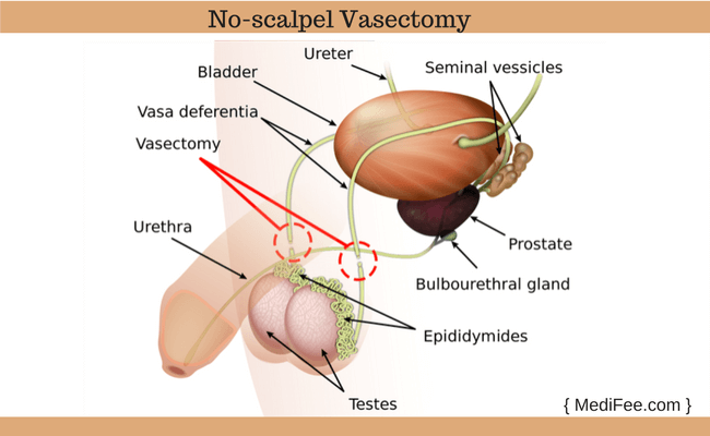 no scalpel vasectomy procedure