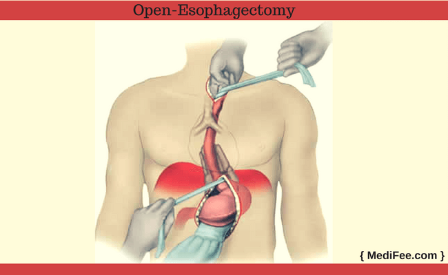 open esophagectomy procedure