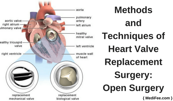 open heart valve replacement