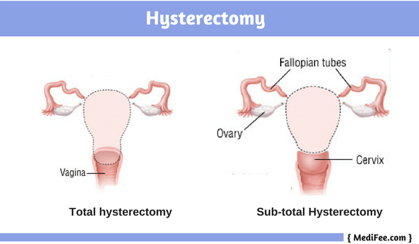 total and subtotal hysterectomy