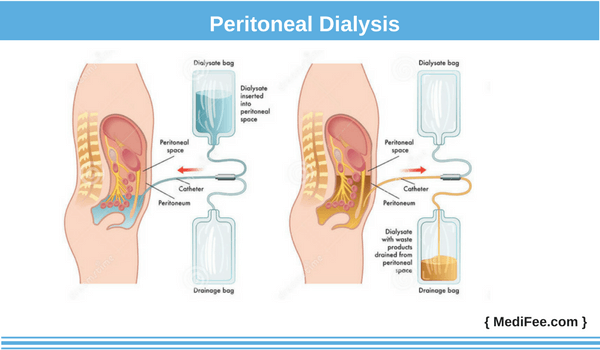 method of dialysis: peritoneal peritoneal method of dialysis