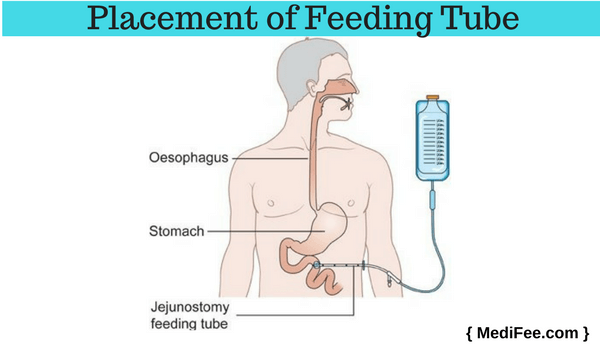 placement of feeding tube