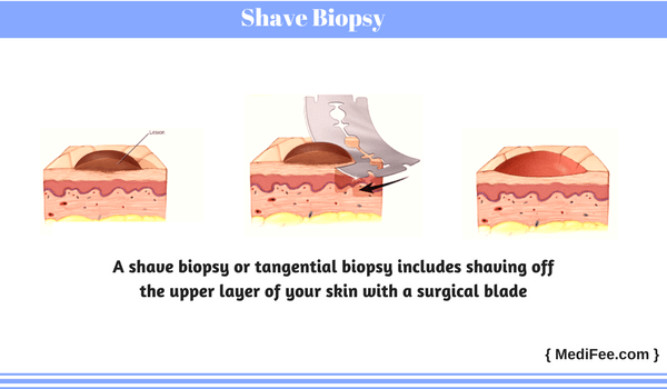 shave biopsy