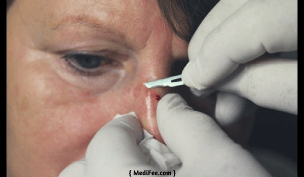 skin cancer surgery skin cancer surgery