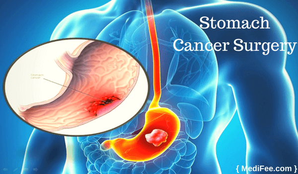 stomach cancer surgery