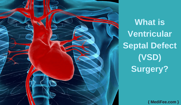 what is ventricular septal defect