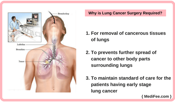 Why is Lung Cancer Surgery Required